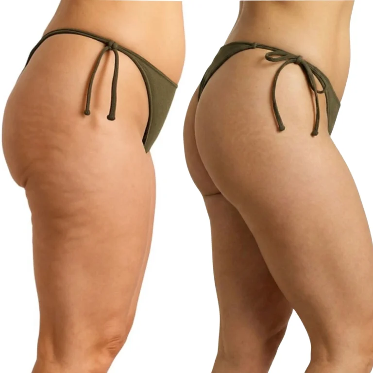 Side-by-side comparison of a woman’s upper thighs and buttocks in a green bikini bottom, showing visible cellulite on the left and smoother skin appearance on the right.